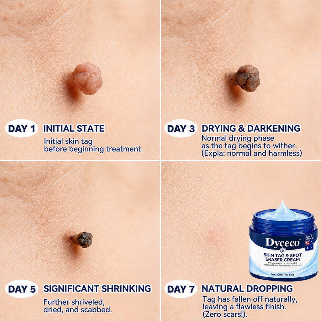 Dyceco® 🚑7-𝐃𝐚𝐲 𝐒𝐤𝐢𝐧 𝐓𝐚𝐠 & 𝐒𝐩𝐨𝐭 𝐄𝐫𝐚𝐬𝐞𝐫 𝐂𝐫𝐞𝐚𝐦 (Zero Pain, Zero 𝐒𝐜𝐚𝐫𝐬 Formula)
