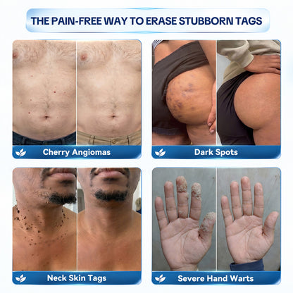 Dyceco® 🚑7-𝐃𝐚𝐲 𝐒𝐤𝐢𝐧 𝐓𝐚𝐠 & 𝐒𝐩𝐨𝐭 𝐄𝐫𝐚𝐬𝐞𝐫 𝐂𝐫𝐞𝐚𝐦 (Zero Pain, Zero 𝐒𝐜𝐚𝐫𝐬 Formula)