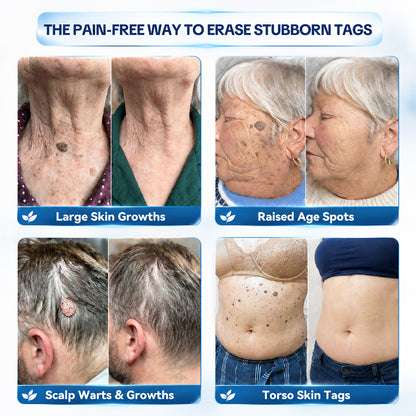 Dyceco® 🚑7-𝐃𝐚𝐲 𝐒𝐤𝐢𝐧 𝐓𝐚𝐠 & 𝐒𝐩𝐨𝐭 𝐄𝐫𝐚𝐬𝐞𝐫 𝐂𝐫𝐞𝐚𝐦 (Zero Pain, Zero 𝐒𝐜𝐚𝐫𝐬 Formula)